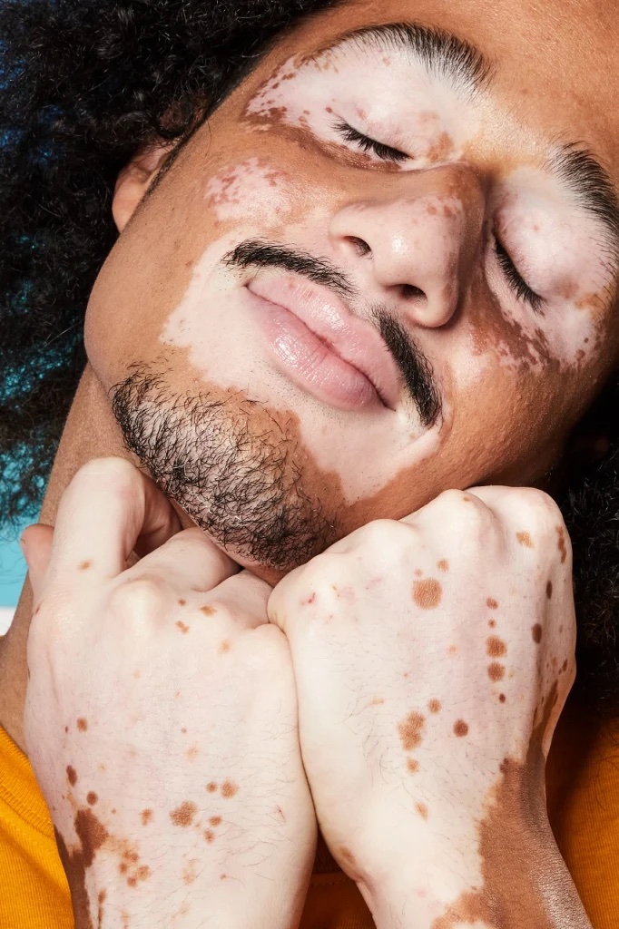 vitiligo causas tratamento