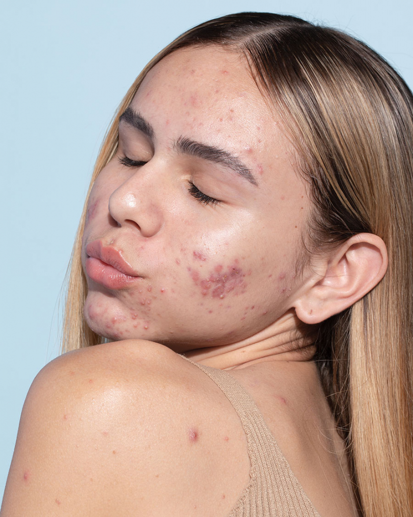 maquiagem causa acne